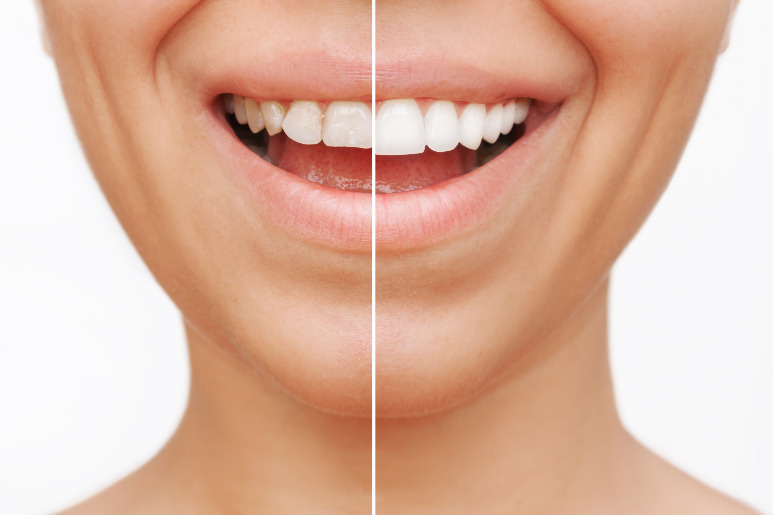 <strong>Veneers:</strong> Der perfekte Look für Ihr Lächeln